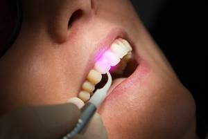 Bleaching, Zahnarztpraxis Lohmen Dr. Haupt