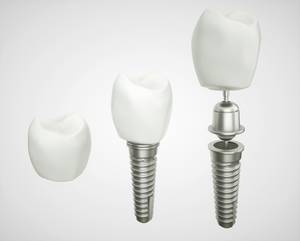 Zahn-Implantate, Zahnarztpraxis Lohmen Dr. Haupt